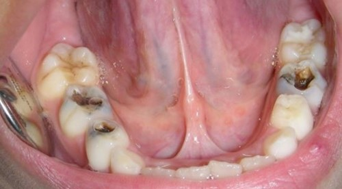 Dấu hiệu răng cần điều trị tủy