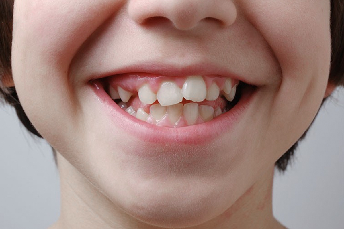 Răng lệch nhân trung còn tác động mạnh mẽ đến thẩm mỹ nụ cười cũng như tâm lý người bệnh