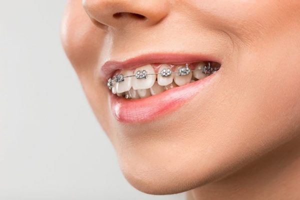 Niềng răng là phương pháp điều trị an toàn và hiệu quả nhất