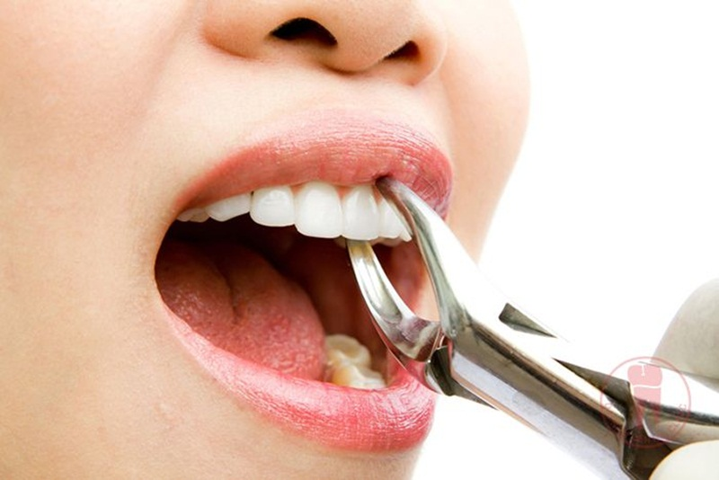 Nhổ răng cửa khi thực hiện đúng quy trình, có sự giám sát của bác sĩ là phương pháp an toàn, ít gây đau đớn
