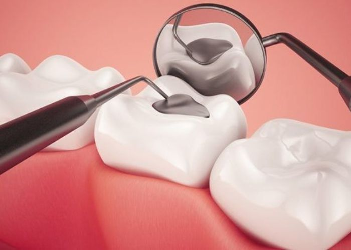 Sau khi hoàn tất các bước cần trám kín lối vào kênh răng để bảo vệ vùng tủy đã được điều trị
