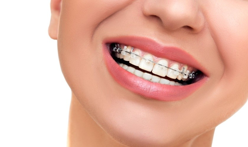 Khi quá trình điều trị niềng răng kết thúc các răng có thể sắp xếp chồng khít vào nhau một cách hoàn hảo chính
