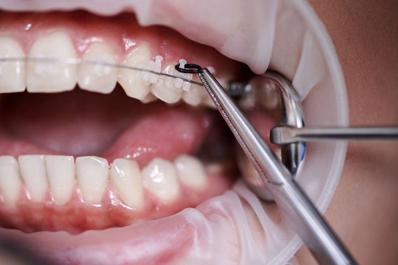 Quy trình tháo niềng răng như thế nào là an toàn?