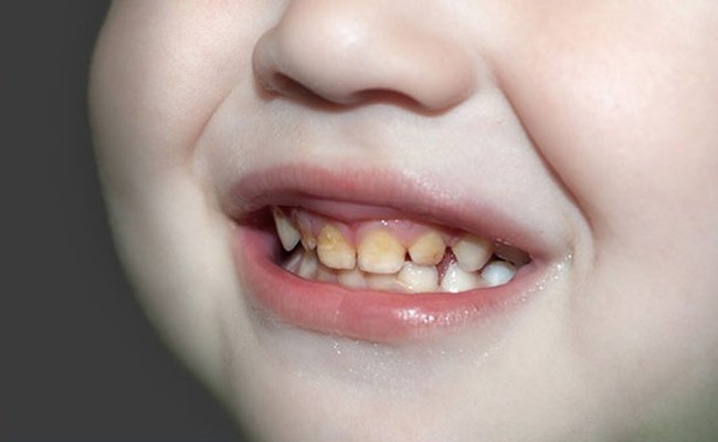 Thiếu hụt một số enzym và protein trong nước bọt có thể dẫn đến răng bé dễ bị vàng hơn