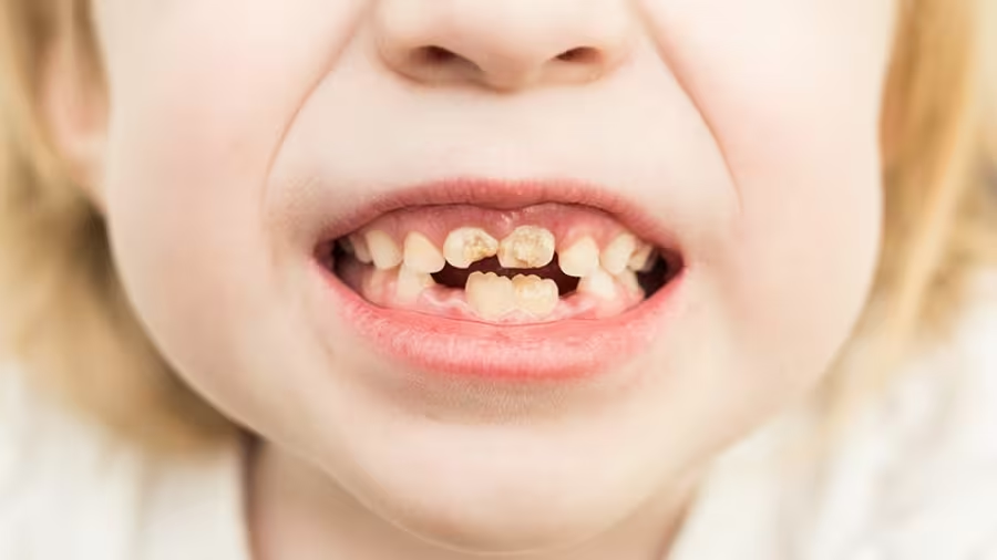 Hậu quả của tình trạng răng vàng ở trẻ