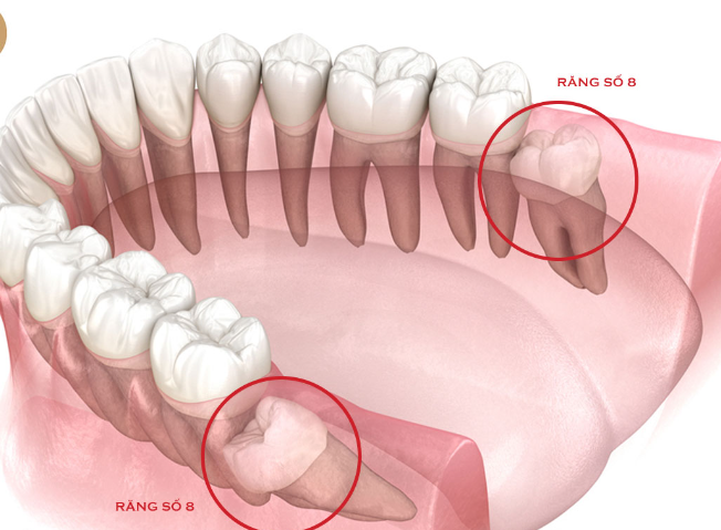 Nhổ 2 răng khôn cùng lúc có nguy hiểm không?