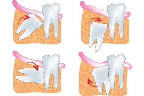 Tình trạng ban đầu của răng khôn như vị trí mọc, hình dạng răng, số lượng rễ,...sẽ quyết định độ khó của ca phẫu thuật