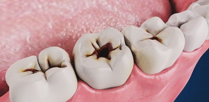 Sâu răng lan rộng trong miệng