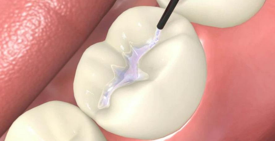 Trám răng là giải pháp điều trị được sử dụng phổ biến nhất cho răng sâu ở mức độ vừa và nhẹ