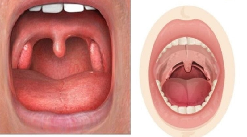Hình ảnh vòm họng của người bình thường
