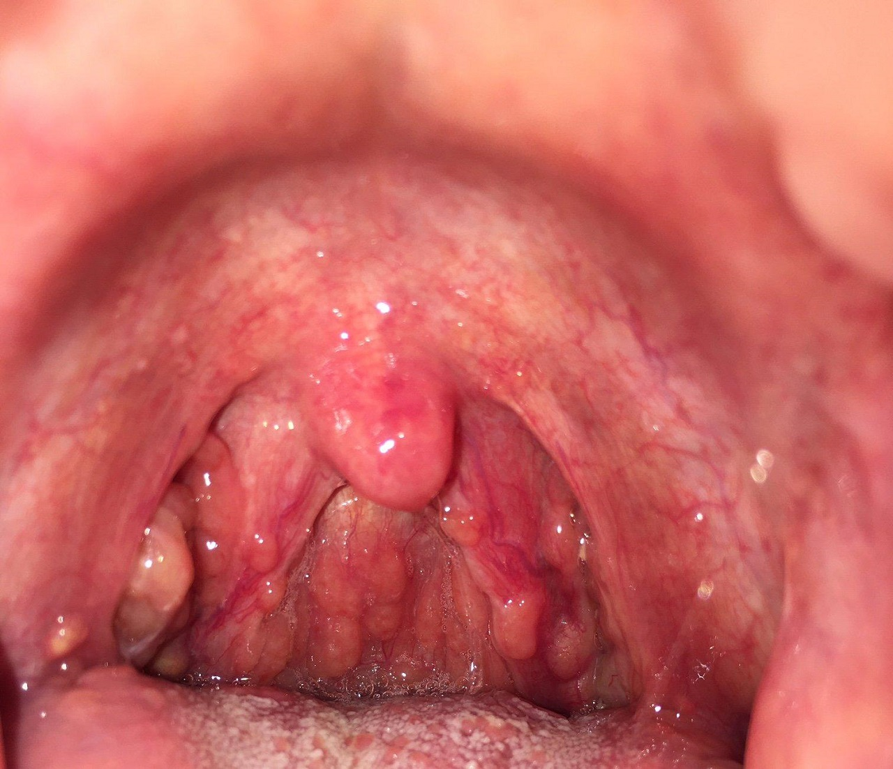 Bệnh viêm họng hạt trắng
