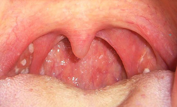 Ung thư vòm họng là một bệnh lý nặng nề