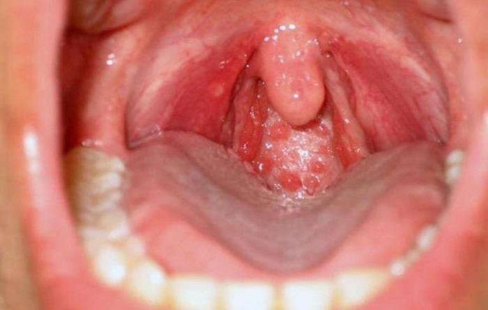 Bệnh ung thư vòm họng thường dễ bị nhầm lẫn với các vấn đề họng thông thường