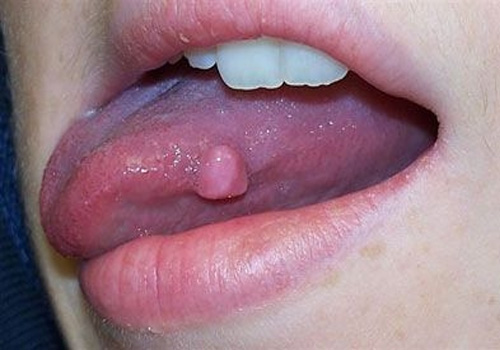 Dưới lưỡi nổi cục thịt có thể là dấu hiệu cảnh báo về một số loại bệnh lý
