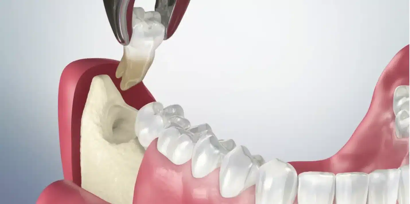 Do thao tác khi nhổ răng khôn làm vùng họng bị tổn thương