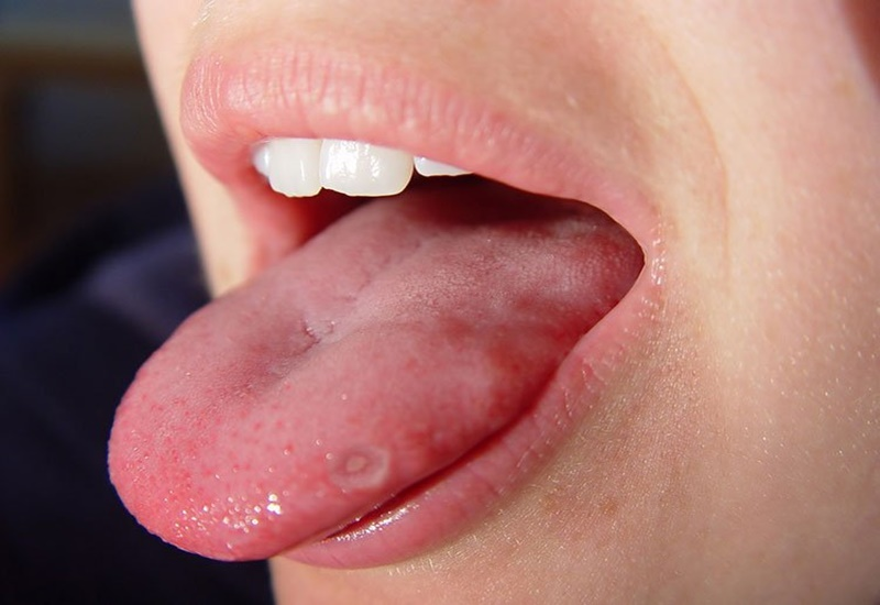Nguyên nhân lưỡi có đốm đỏ