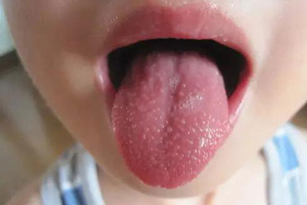 Lưỡi nổi đốm đỏ ở trẻ em