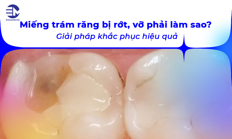 miếng trám răng bị rớt