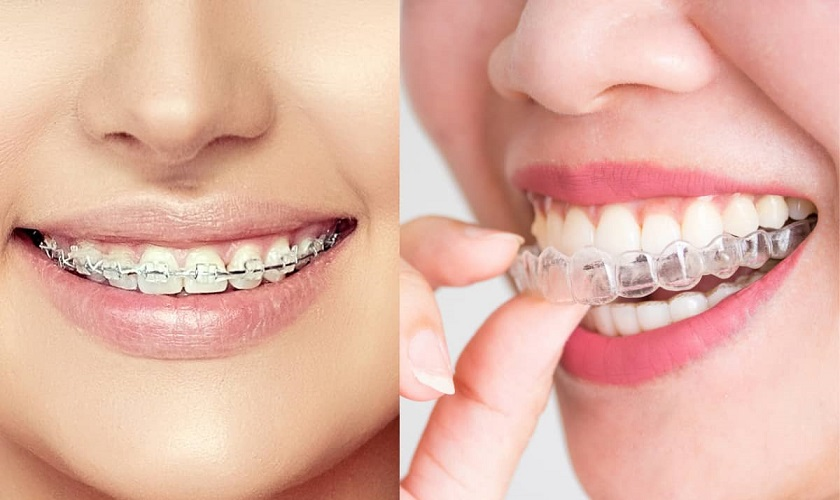 Có 2 phương pháp niềng răng phổ biến hiện nay là niềng răng mắc cài và niềng răng trong suốt