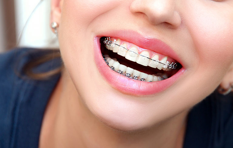 Thời gian 20 tuổi niềng răng dao động trung bình từ 12-24 tháng
