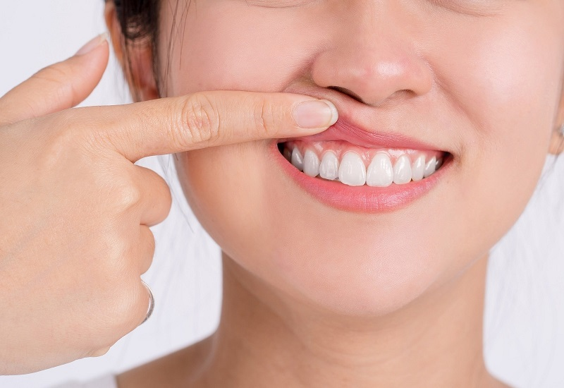 Răng sứ Orodent là một trong những dòng răng sứ thẩm mỹ chất lượng và an toàn bậc nhất thế giới