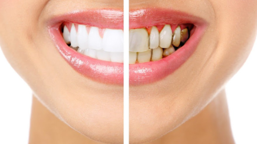 Răng sứ Orodent có khả năng tạo ra hiệu ứng ánh sáng chiết quang long lanh khi cười