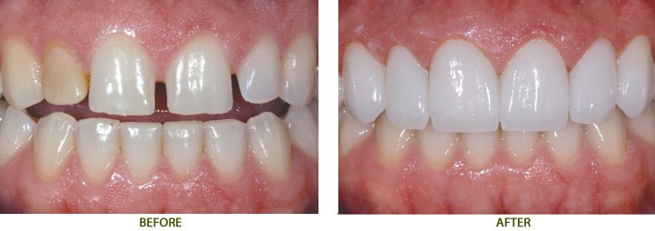 Răng sứ Orodent có thể áp dụng điều trị thành công trong nhiều trường hợp khác nhau