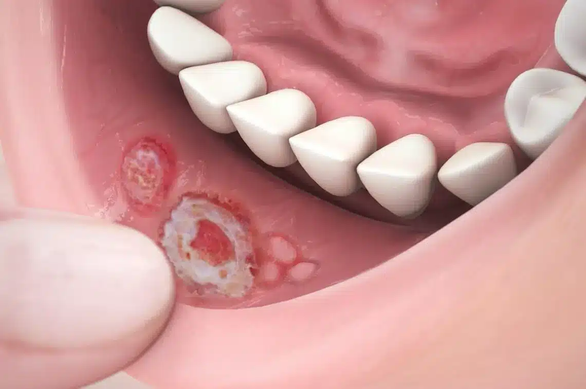 Xuất hiện các mảng bám màu trắng/vàng ở niêm mạc miệng là triệu chứng dễ nhận biết nhất của bệnh