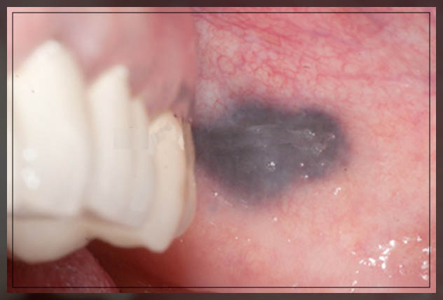Biểu hiện của khối u máu trong khoang miệng