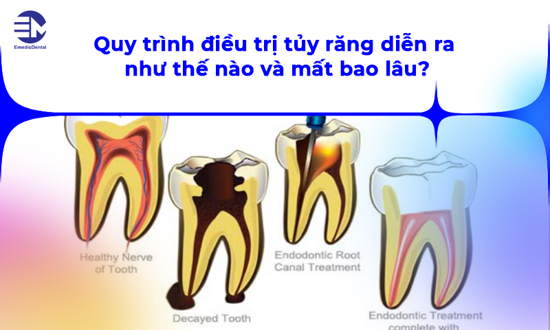 quy trình điều trị tủy răng