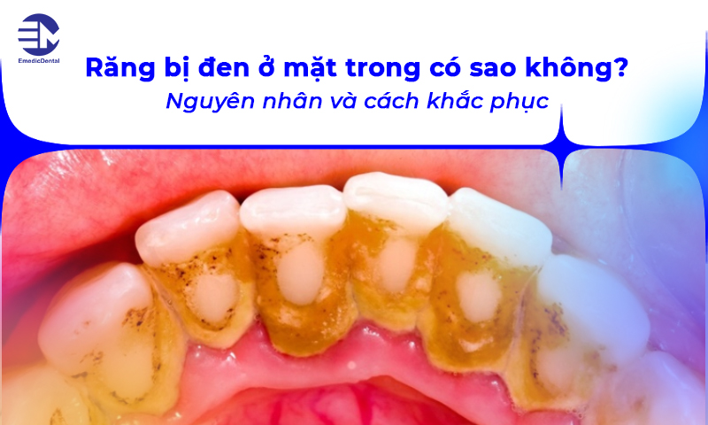 Răng bị đen ở mặt trong có sao không? Nguyên nhân và cách khắc phục