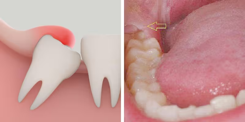 Răng khôn được xem là răng đặc trưng của giai đoạn răng vĩnh viễn