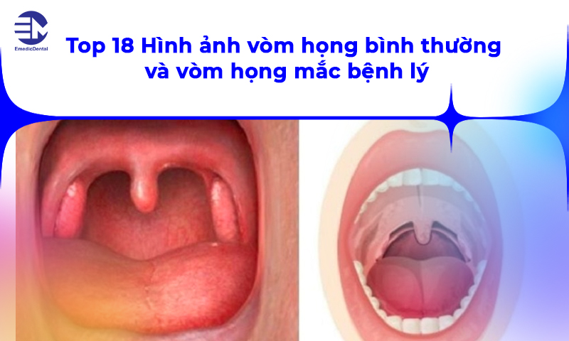 vòm họng bình thường