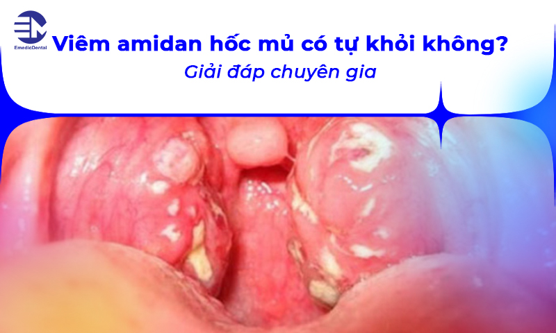 viêm amidan hốc mủ có tự khỏi không