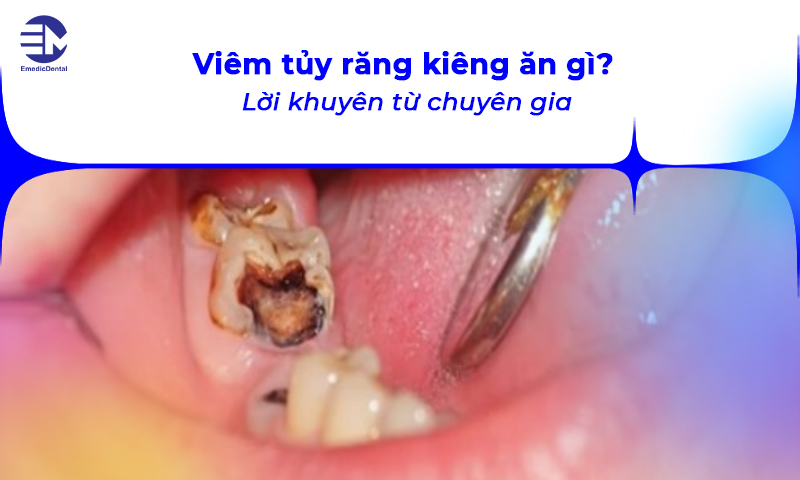 viêm tuỷ răng kiêng ăn gì