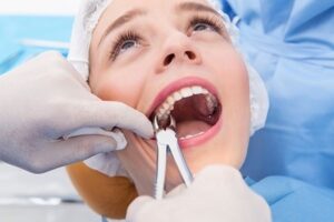 Răng khôn mọc lệch là một trong số các trường hợp được bác sĩ chỉ định nhổ bỏ răng hàm