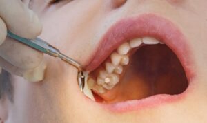Các phương pháp nhổ răng hàm hiện nay