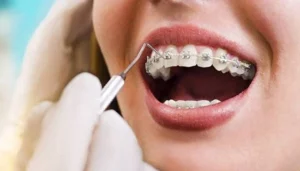 Các yếu tố ảnh hưởng đến độ nhanh hay chậm của việc niềng răng