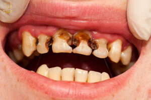 Nguyên nhân gây đau răng